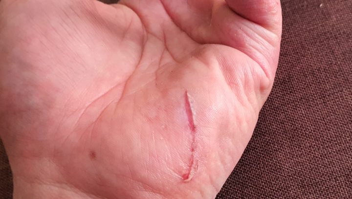 自転車事故の怪我(治りかけ)